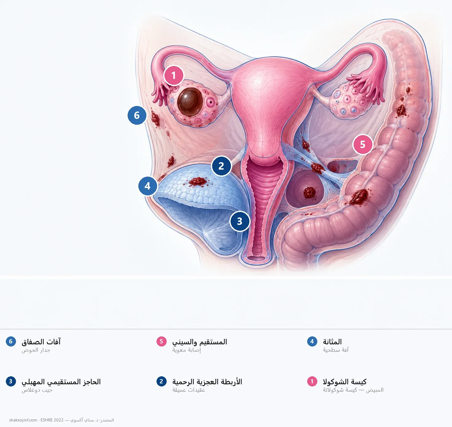 الانتباذ البطاني الرحمي: الأعراض والتشخيص والعلاج والخصوبة