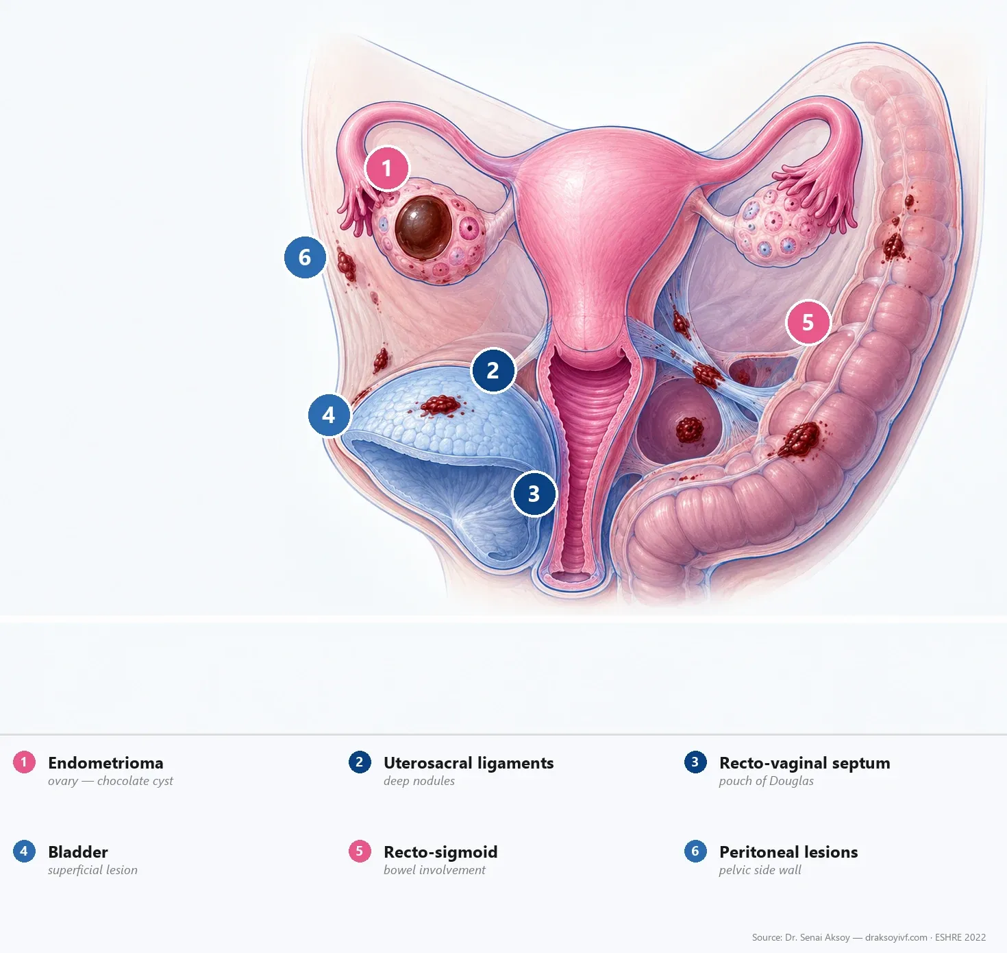 Endometriosis: Symptoms, Diagnosis, Treatment and Fertility