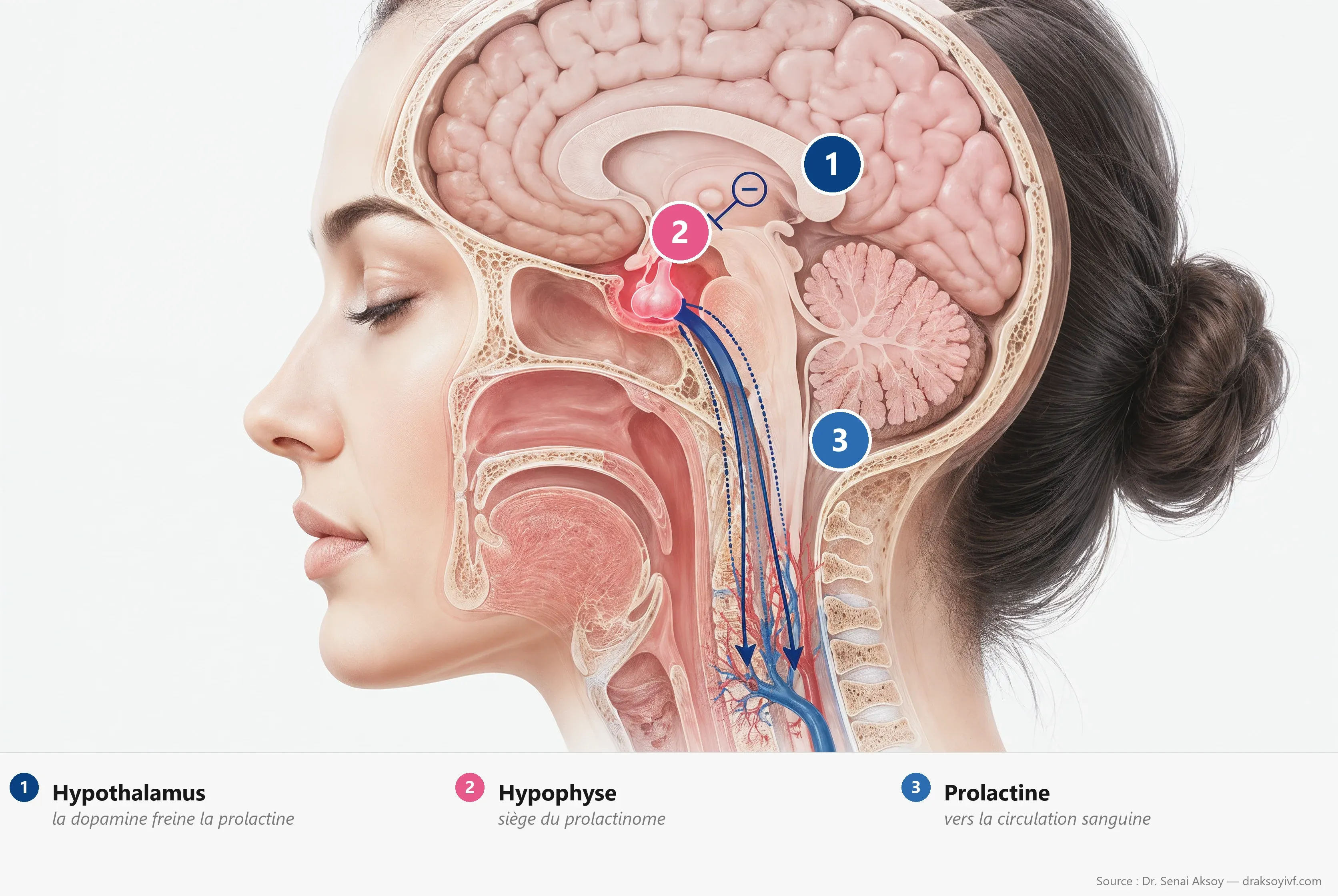 Hyperprolactinémie : causes, diagnostic, traitement et fertilité