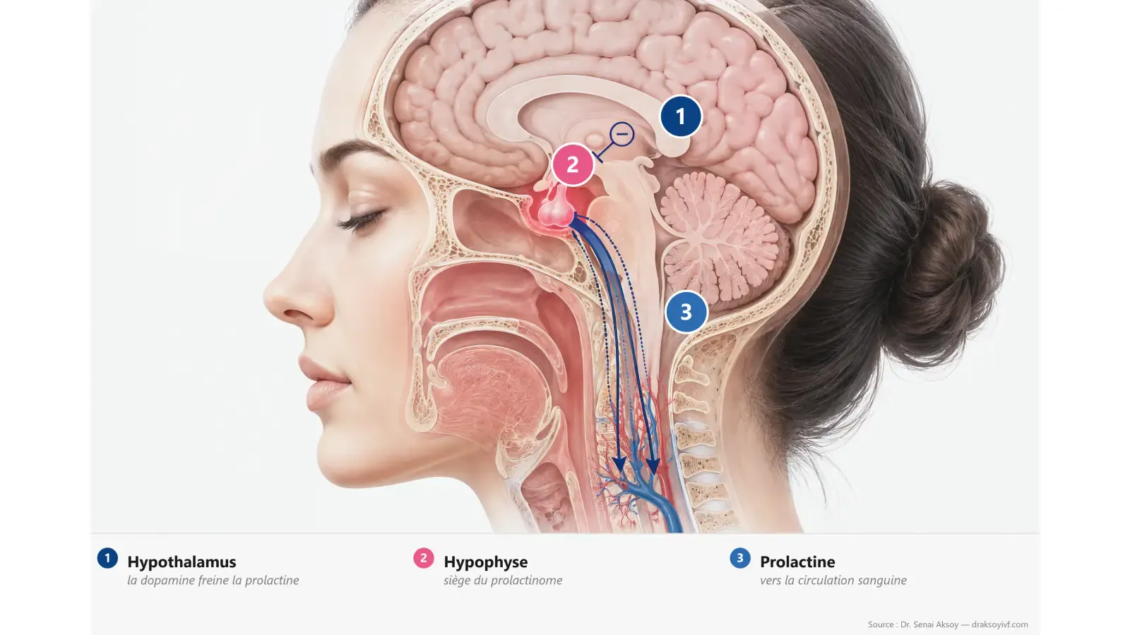 Prolactine élevée chez la femme (hyperprolactinémie)